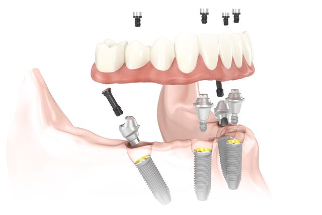 Procedimiento de colocación de implantes All on4 / All on 6