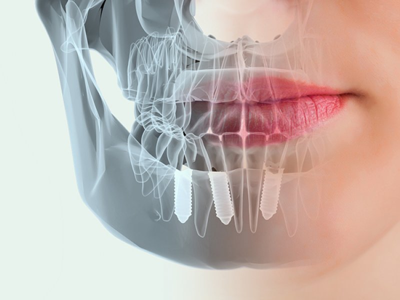 Implantologia immediata. Dentadura fixa el mateix dia