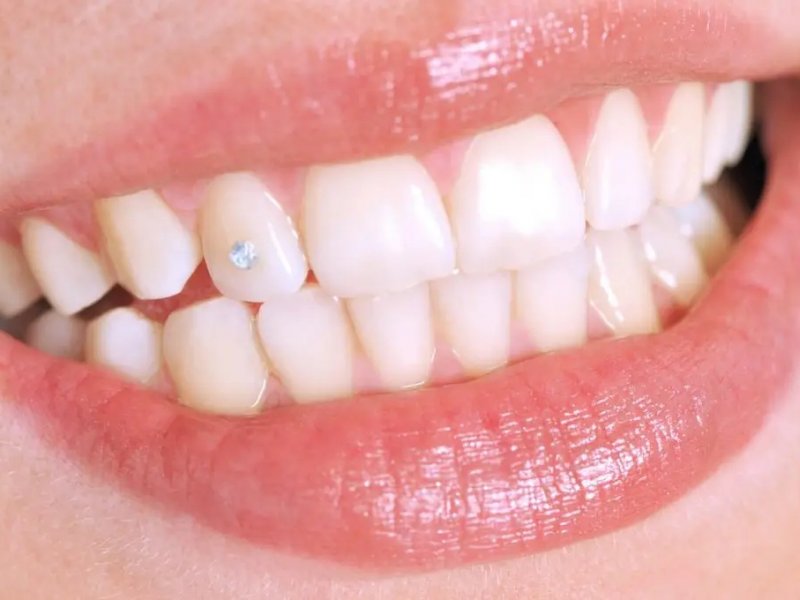 Piercing dental, aplicación y duración